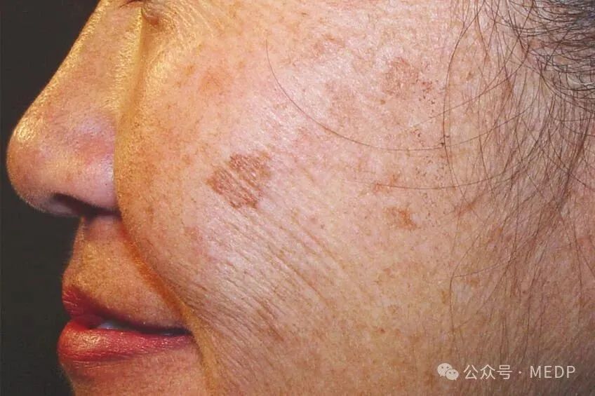 老年斑、晒斑、日光性雀斑是一回事吗？